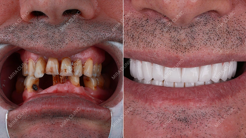 Before and After: Real Dental Implant Result